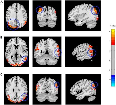 Resting-State Functional MRI Metrics in Patients With Chronic Mild Traumatic Brain Injury and Their Association With Clinical Cognitive Performance